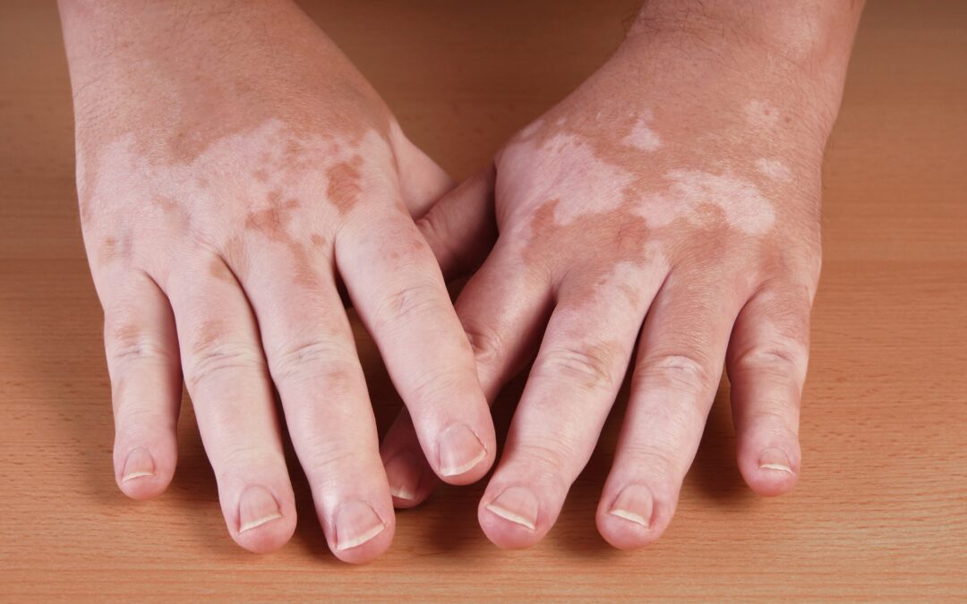 Could Your Cold Fingers and Toes Be Raynaud’s Syndrome?